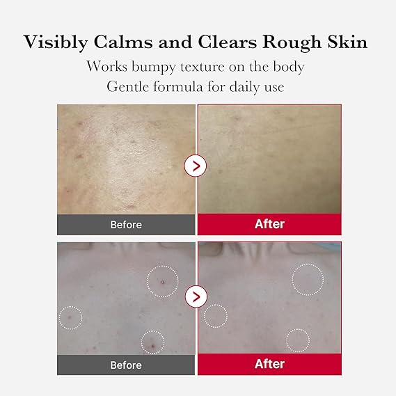 [Medicube] Red Acne Body Peeling Shot 3.88 oz (110g)