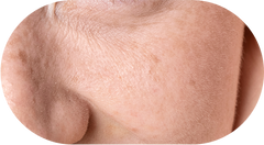 Dry Skin