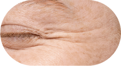 Wrinkled Skin